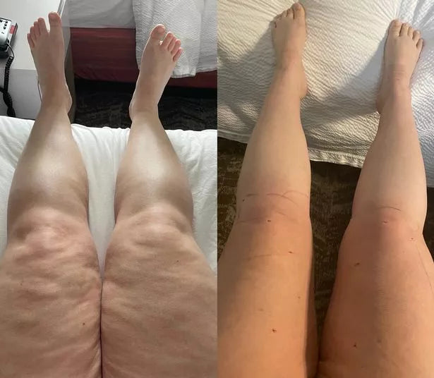 Leg transformation