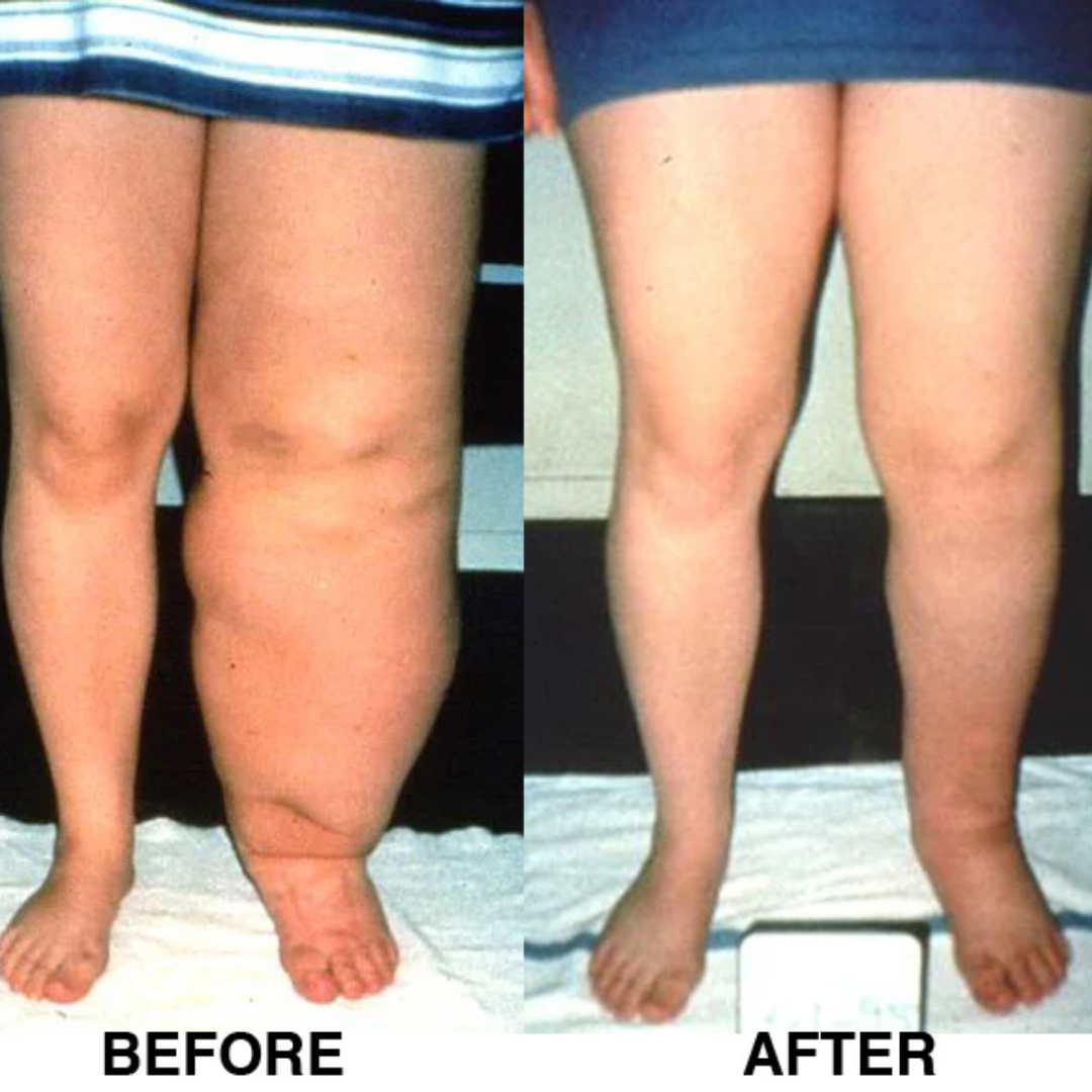 Leg transformation