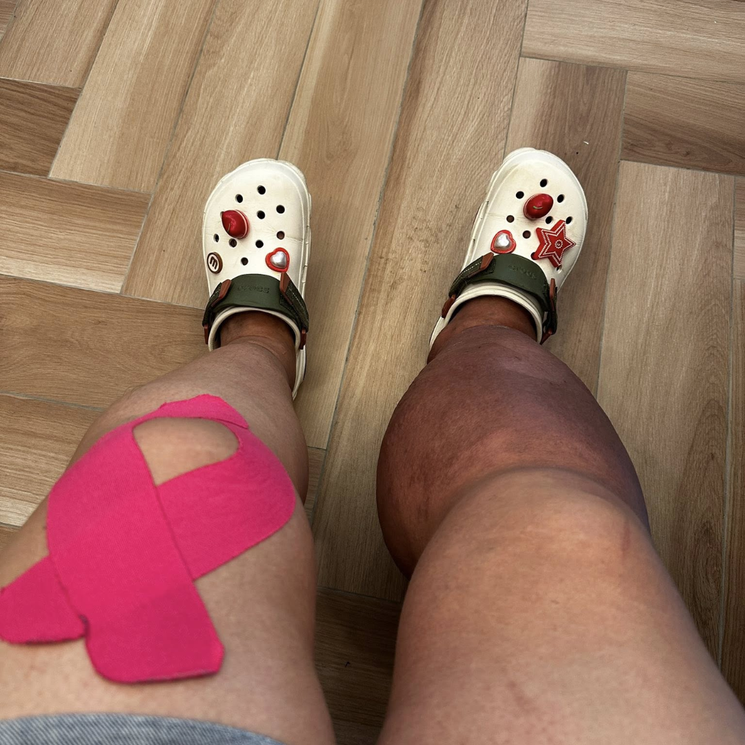 Living with lymphedema