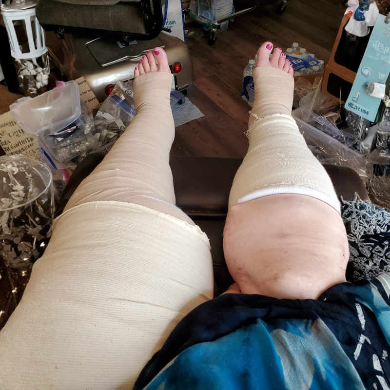 Before and after comparison of swollen legs