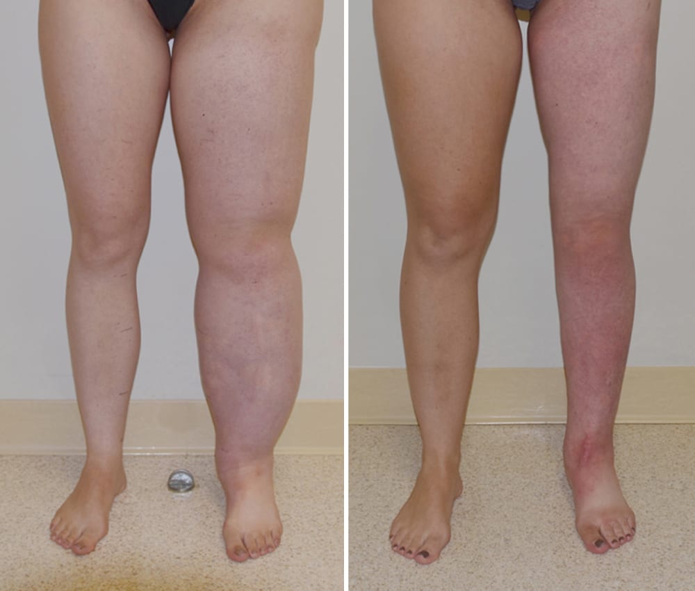 Leg transformation